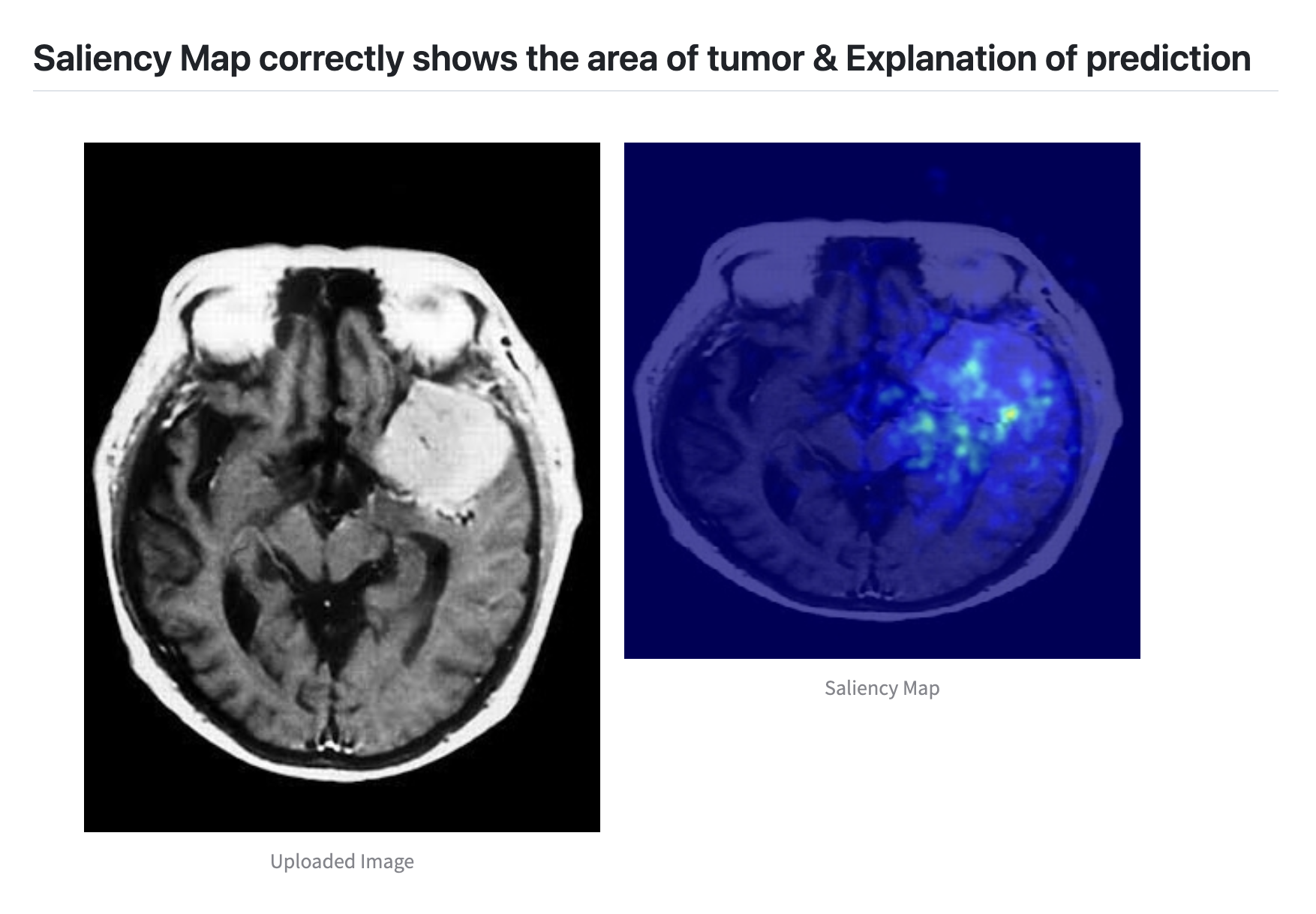 Brain Tumor Classification